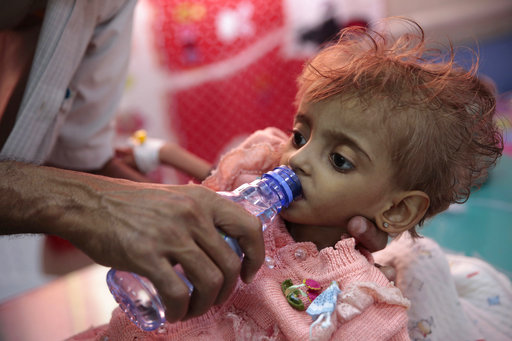 In this Thursday, Sept. 27, 2018, file photo, a father gives water to his malnourished daughter at a feeding center in a hospital in Hodeida, Yemen. [File photo: AP]