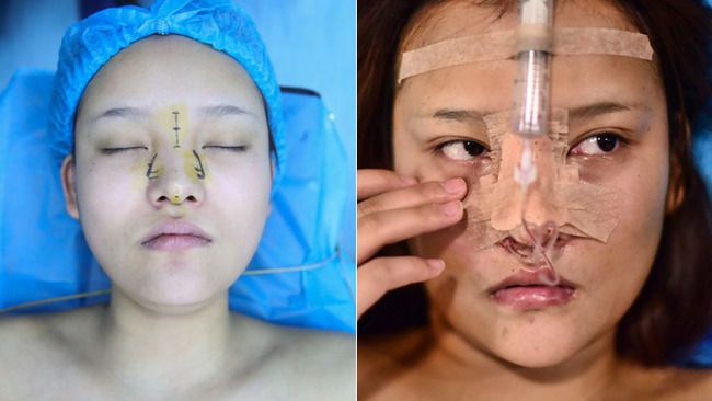 A 20-year-old woman has plastic surgery on her nose. [Photo: IC]